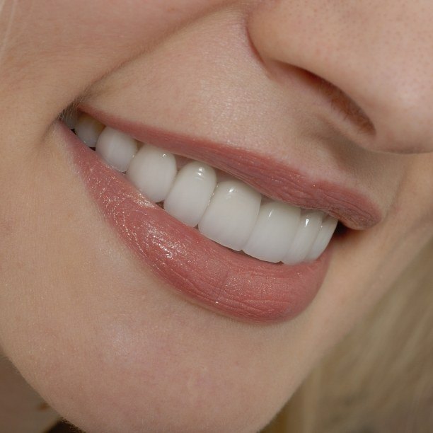 Closeup of flawless smile after makeover