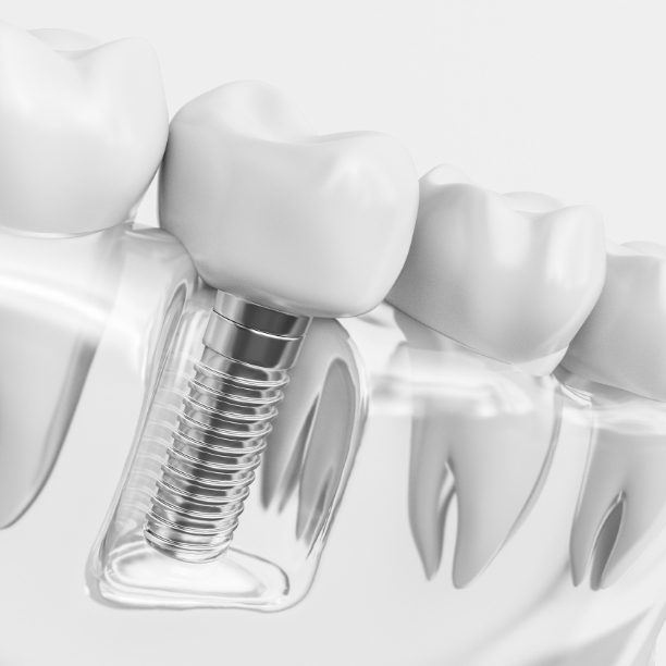 Animated smile with dental implant supported replacement tooth