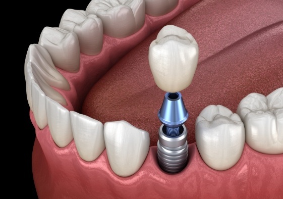 Animated smile during dental implant supported dental crown placement