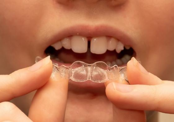 Closeup of dental patient with gaps between teeth placing an Invisalign tray