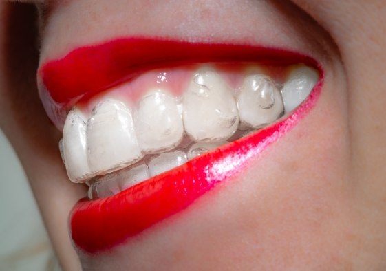 Closeup of dental patient using Invisalign to correct bite alignment