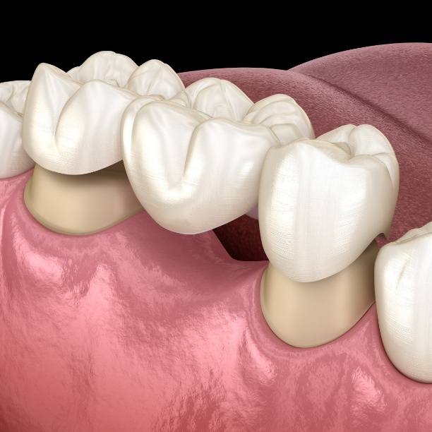 Animated smile with dental bridge replacing missing teeth