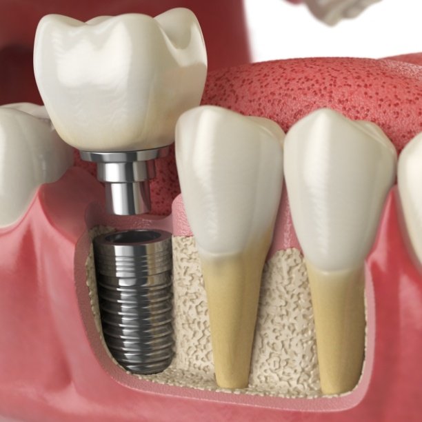 Animated smile with dental implant supported replacement tooth