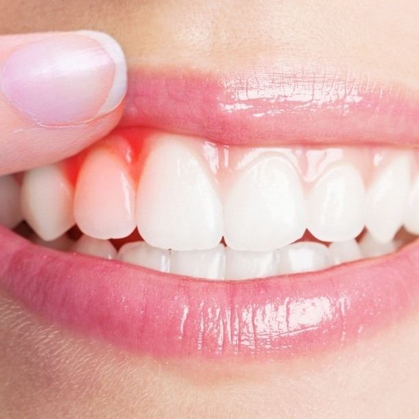 Closeup of damaged smile before gum disease treatment