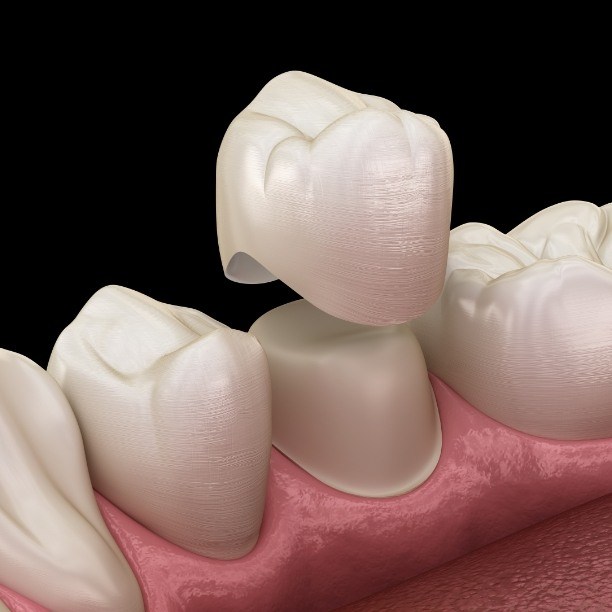 Animated smile during dental crown restorative dentistry treatment