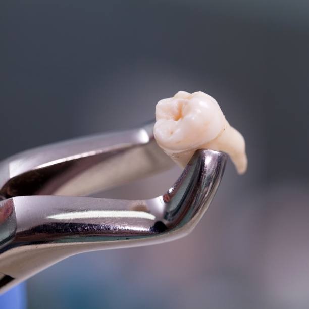 Metal clasp holding a tooth after extraction