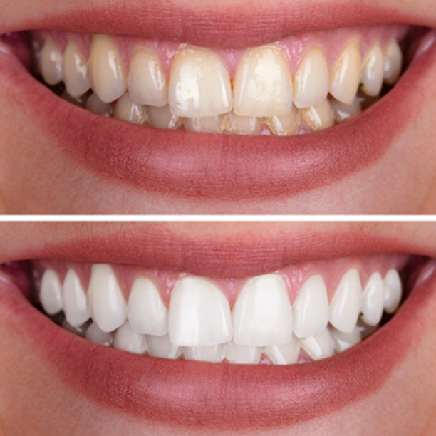 Person’s smile before and after teeth whitening