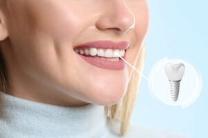 Woman smiling with dental implant insert pictured. 