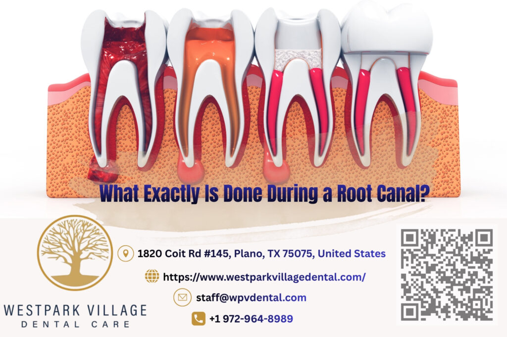 What Exactly Is Done During a Root Canal?