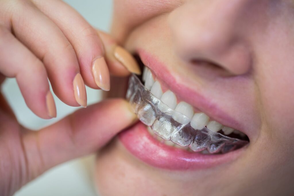 Invisalign vs Braces in Plano TX: Which Is Better?