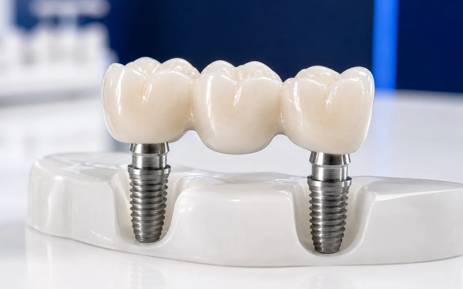 Model of implant bridge