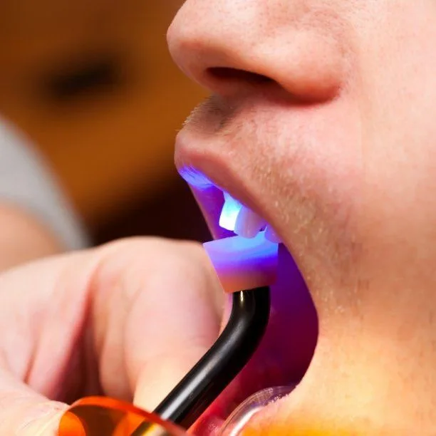 Cosmetic dental bonding being shaped onto a front tooth