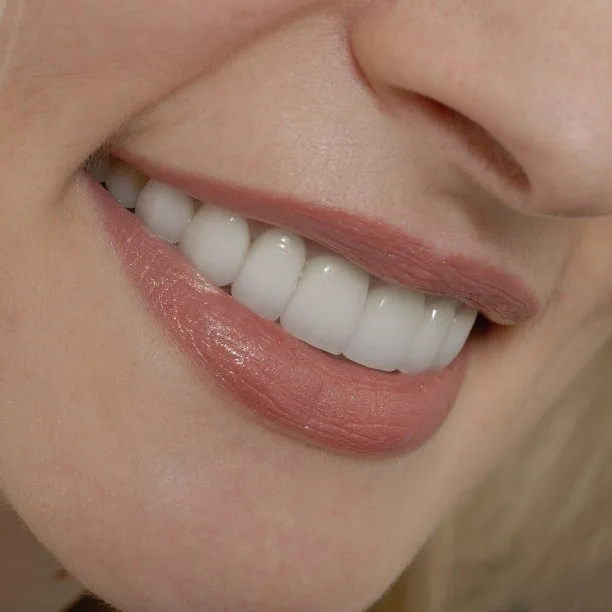 Closeup of flawless smile after makeover