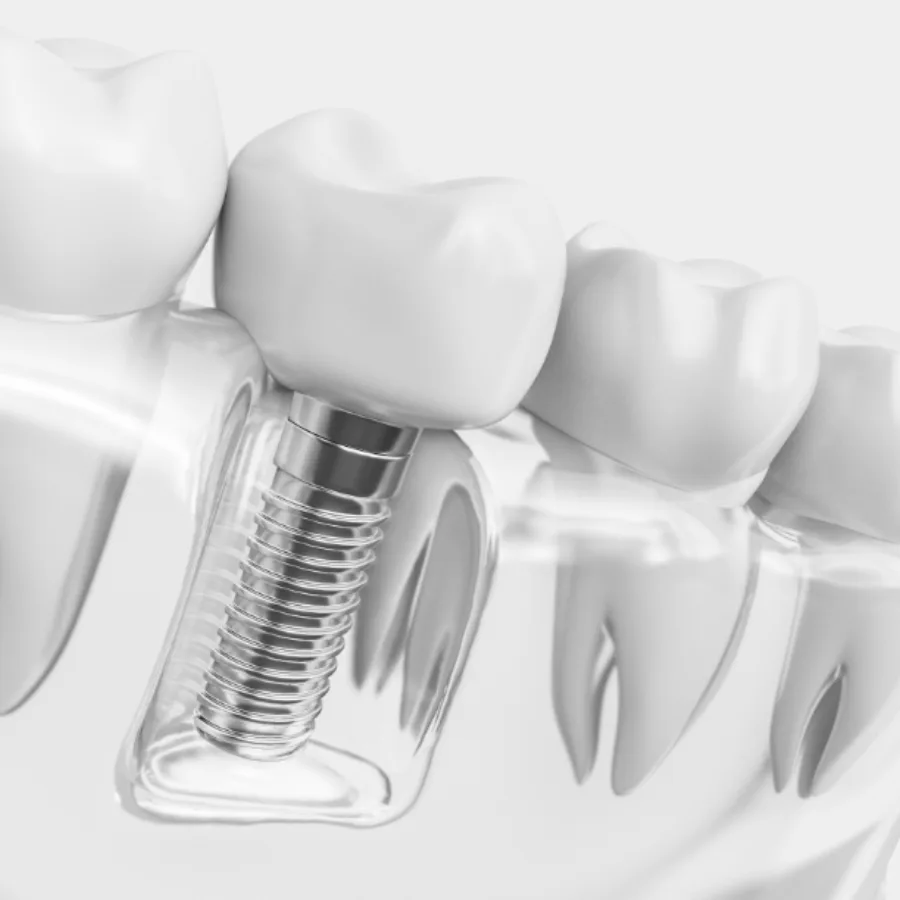 Animated smile with dental implant supported replacement tooth