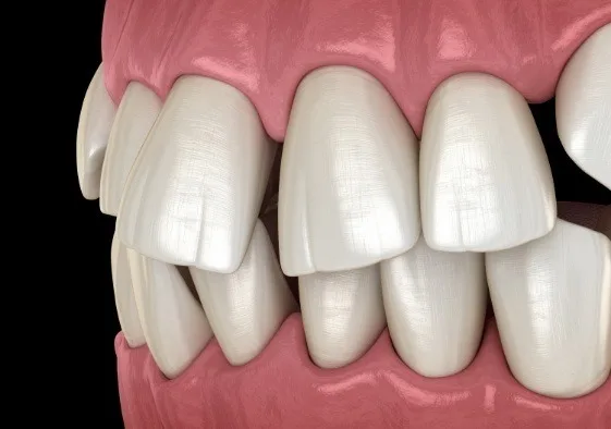Animated smile with crowded teeth before clear aligner treatment