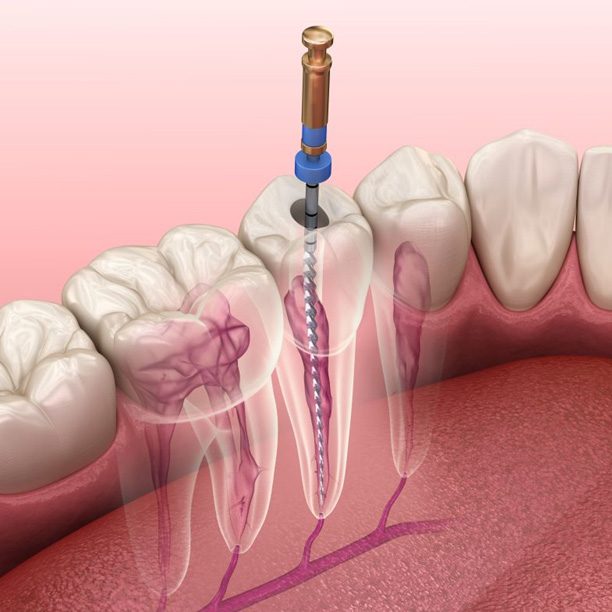 Illustration of dental instrument being used to perform root canal therapy