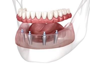 Depiction of implant dentures